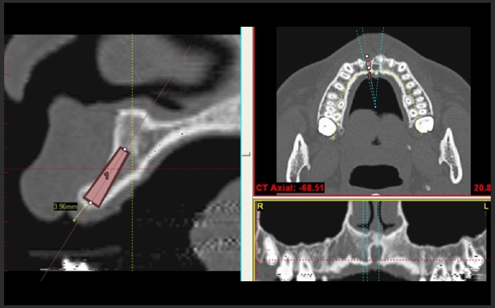 3D電腦斷層 微創植牙