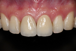 門牙全瓷假牙案例