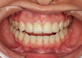 全瓷冠假牙之矯正病患