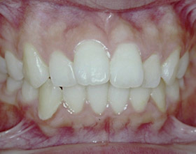 proimages/case/ortho/teet02-1.jpg