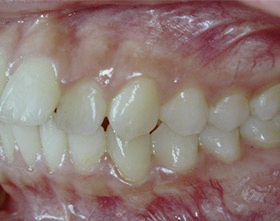 proimages/case/ortho/teet02-2.jpg