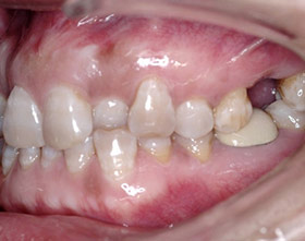 proimages/case/ortho/teeth01-1.jpg