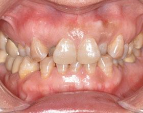 proimages/case/ortho/teeth01-2.jpg