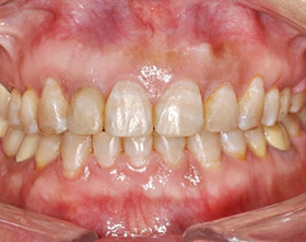 proimages/case/ortho/teeth01-4.jpg