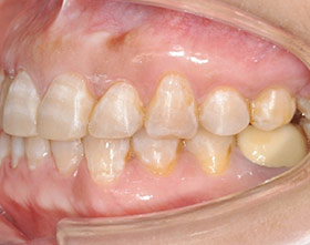 proimages/case/ortho/teeth01-5.jpg