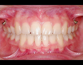 proimages/case/ortho/teeth02-4.jpg