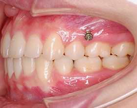 proimages/case/ortho/teeth02-5.jpg